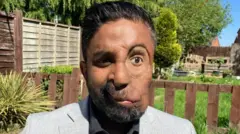 Amit Goš je rođen sa neurofibromatozom tipa 1.