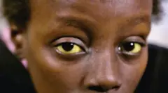 afrika orak hücre anemisi 