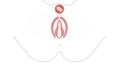 Gráfico de una infibulación genital femenina.