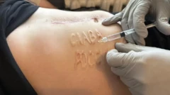 Украин шифокорлари тамғани ўчиришга тайёргарлик кўрмоқда