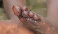 Amavunja ku kirenge cy'umwana i Musanze