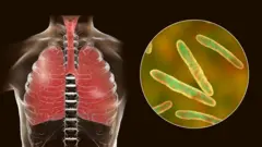 Кыргызстанда жылына кургак учукту 4000-5000ге чукул киши жуктурат.