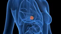 Tumor en el cerebro. 