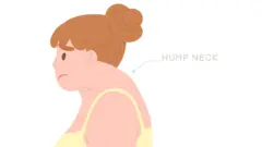 नेक हंप टाळायचा कसा?