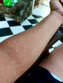 Braço de Hansel com manchas na pele