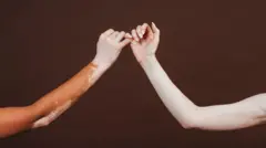 শ্বেতী রোগ