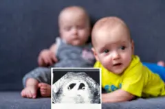 IVF मुळे जुळी किंवा तिळी मुलंच जन्माला येतात का? जाणून घ्या IVF बद्दल सर्वकाही