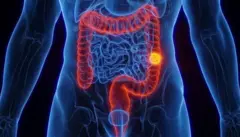 L'augmentation de ce type de cancer chez les jeunes inquiète les scientifiques.