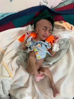 ብሕጽረት መኣዛዊ ምግቢ ዝተጠቕዐ ህጻን