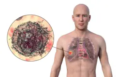 ‘मी आयुष्यात कधी सिगरेट ओढली नाही, मग मला कॅन्सर कसा झाला?'; जाणून घ्या फुफ्फुसाच्या कॅन्सरबद्दल सर्वकाही