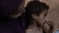 وزارت بهداشت تحت کنترل حماس ده‌ها مورد مرگ ناشی از سوءتغذیه را گزارش کرده است.