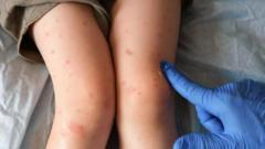 El condado en EE.UU. donde el sarampión comienza a sentirse como la nueva pandemia