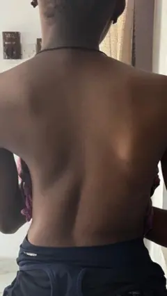 Foto nwatakịrị nwere Scoliosis