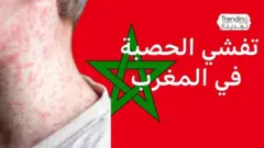 الحصبة تتفشى في المغرب ومطالبات بإعلان "الطوارئ الصحية"