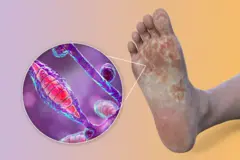 Athletes Foot