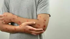 ఎంపాక్స్