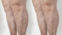 సిరల వాపు