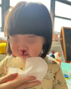 "เขาเริ่มจามได้เองก็จามออกมาเป็นเลือด" สำรวจผลกระทบมลพิษทางอากาศในเชียงใหม่ ต่อสุขภาพของเด็กเล็ก