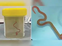 मानिसको मस्तिष्कबाट निकालिएको जुका