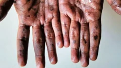 எம்பாக்ஸ் (குரங்கம்மை) தொற்றுநோய் எவ்வளவு ஆபத்தானது