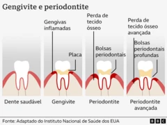 Um gráfico mostrando como a doença gengival se desenvolve em dentes saudáveis