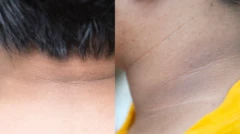अकान्थोसिस निग्रिकन्स Acanthosis nigricans  BBC Marathi Health बीबीसी मराठी आरोग्य