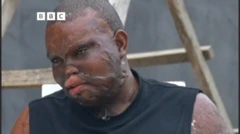 Promise Okwara wọ aṣọ dúdú, ó ń wo ẹ̀gbẹ́, àpá ara jíjónà wà lójú àti apá rẹ̀