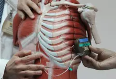 Desfibrilador implantable