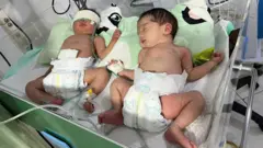 Two very young babies kept in a incubator support. Baby on the left has an eye injury. 