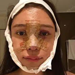 Uma jovem com um curativo marrom espesso cobrindo quase todo o nariz e boa parte do rosto. Uma bandagem branca envolve a borda do rosto, incluindo o queixo, e há sinais de hematomas e sangue em partes do rosto.