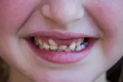 Ọmọdé tó fẹ eyín rẹ̀