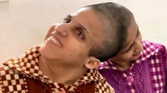 सयामी जुळ्या बहिणी