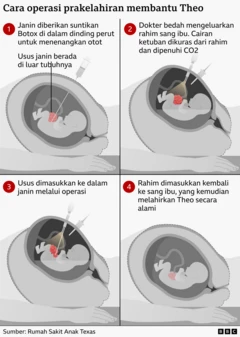 Infografis yang menunjukkan empat langkah operasi prenatal. Janin disuntik Botox di dinding perut untuk mengendurkan otot, ahli bedah sementara membuka rahim dan menggunakan operasi lubang kunci untuk memindahkan usus janin kembali ke dalam tubuh sebelum mengembalikan rahim, memungkinkan kehamilan berlanjut hingga bayi yang sehat lahir secara alami.