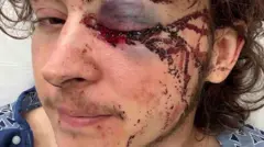 Primer plano de Kaden Rummler con el ojo herido y ropa de hospital en una imagen gráfica.