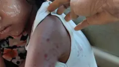 ပေါက်ကွဲမှု အစအနတွေ ထိမှန်ထားတဲ့ကလေးငယ် 