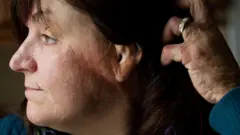 Gina Russo, a survivor of the 2003 Station nightclub fire, holds her hair behind her head as she shows her burn scars on the side of her face.