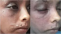 करिश्मा म्हणतात की टीएसडब्ल्यूची लक्षणं काळ्या किंवा सावळ्या त्वचेवर वेगळ्या प्रकारे दिसतात, त्यामुळे त्यांना टीएसडब्ल्यू झाला असल्याचं लक्षात यायला त्यांना थोडा वेळ लागला
