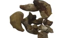 மான் கொம்பு வடிவில் சிறுநீரகத்தில் உருவாகும் கல்