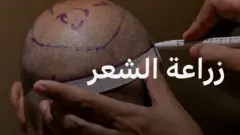 زراعة الشعر