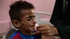 Uma criança desnutrida recebendo alimento