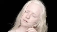 ۱۳ ژوئن مصادف است با روز جهانی آگاهی از آلبینیسم یا زالی