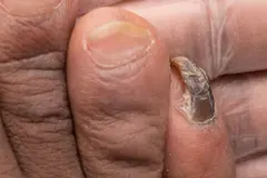Ongle