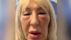در دسامبر ۲۰۲۳، آندریا پس از دریافت فیلرصورت در یک کلینیک زیبایی در شهر هال متوجه شد که اطراف گونه‌هایش آنقدر متورم شده است که نمی‌تواند چشمش را باز کند