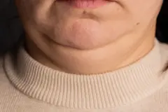 Foto mostrando uma pessoa do lábio inferior até a base do pescoço. A pele do pescoço está um pouco flácida. Ela está vestindo um suéter creme de gola careca.