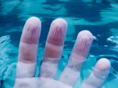 ਝੁਰੜੀਆਂ