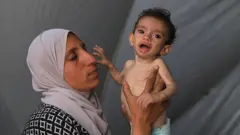 Zakariya, de 11 meses, visiblemente desnutrido, es sostenido por su madre