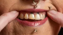 Stacey holds back her top lip with her index fingers showing white top teeth but with dark holes in her gums above the two front incisors . she has a diamond stud in her lower and upper lip and an ornate gold ring in her nose