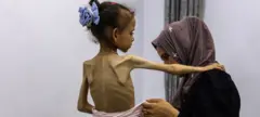 امرأة وطفلة من غزة تعاني سوء التغذية الحاد