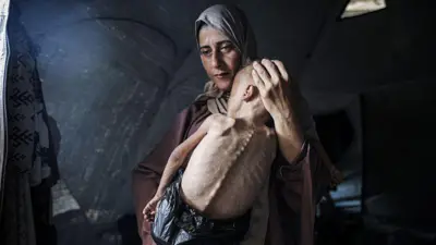 Muhammad Zakariya Ayyoub al-Matouq, un niño de un año y medio de edad en la ciudad de Gaza, con signos de desnutrición aguda