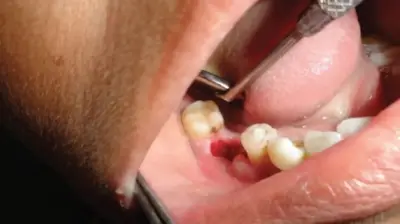 Dry Socket